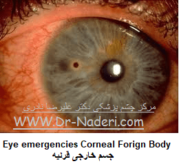  Eye emergencies Corneal Forign Bodyجسم خارجی قرنیه